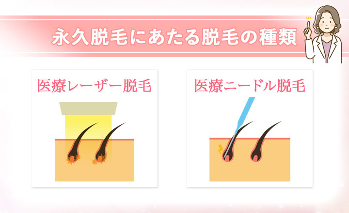 永久脱毛にあたる医療ニードル、医療レーザー脱毛の説明