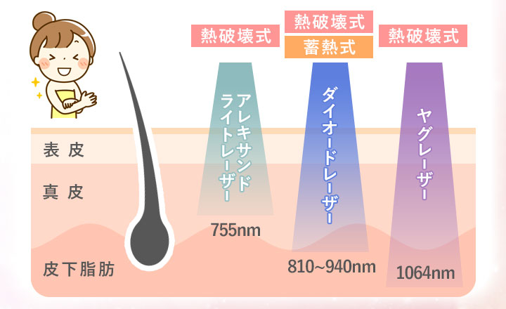 医療脱毛の3つのレーザーの図説