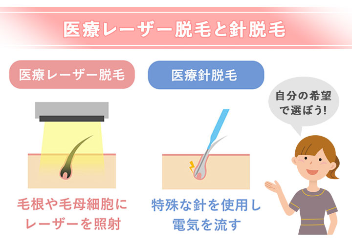 医療脱毛レーザー脱毛や医療針脱毛の違い