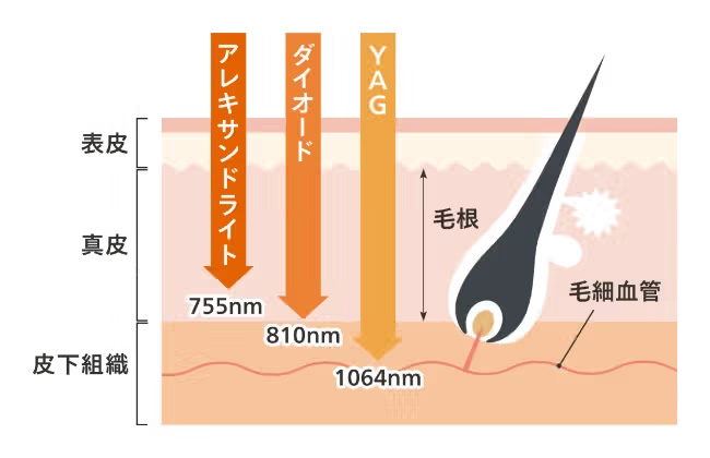 3つのレーザーの特徴