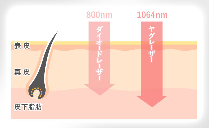 ダイオードレーザーとヤグレーザーの図説