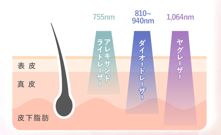 3種類の医療脱毛レーザーの図説