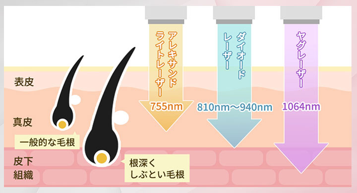 医療脱毛の3つのレーザーの図説