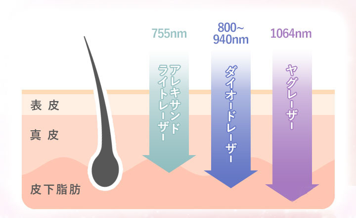 医療脱毛の3つのレーザー