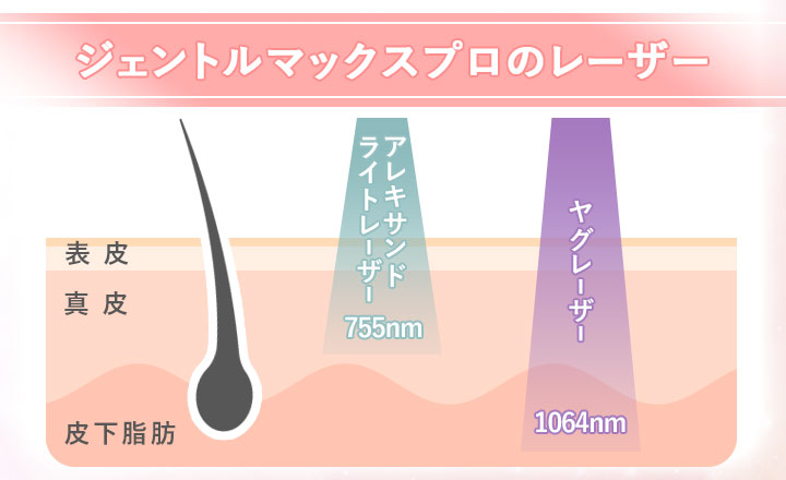 ジェントルマックスプロの2種類のレーザーの図説