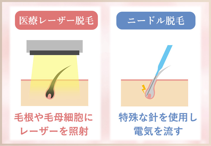 医療脱毛と針脱毛の違い