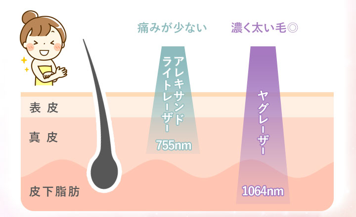 アレキサンドライトレーザーとヤグレーザーの波長の説明イラスト