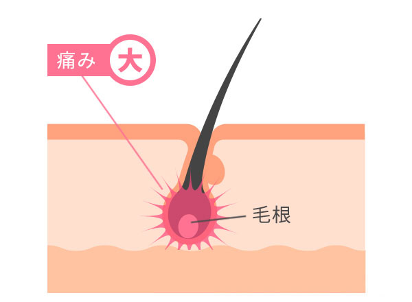 熱破壊式