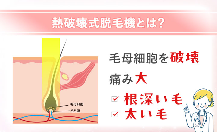 熱破壊式脱毛機の特徴まとめ