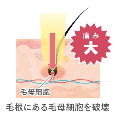 毛根にある毛母細胞を破壊