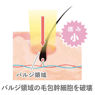 バルジ領域の毛包幹細胞を破壊