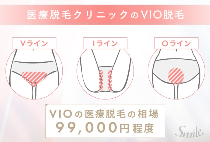 VIO医療脱毛の脱毛範囲と相場